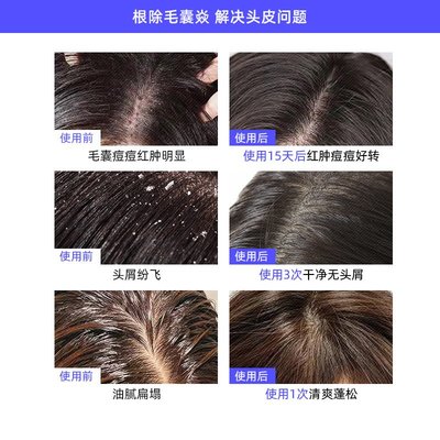 日本毛囊洗發水露液  控油去屑止癢炎頭皮蓬松洗頭膏男女士專用