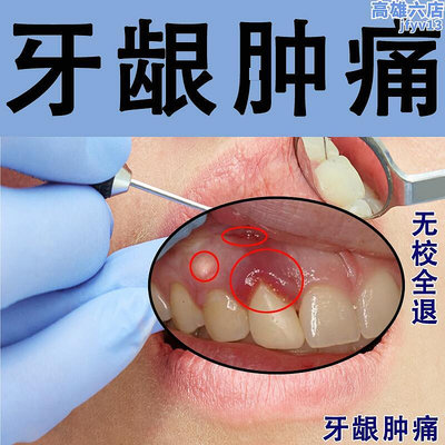 牙齦膿痛腫發炎出血腫痛腫包牙齦萎縮牙齦瘻管牙齦瘤結石牙痛智齒