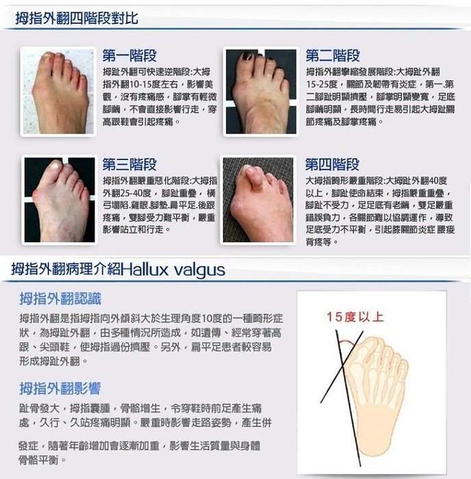 特價出清 矽膠前掌墊脚趾重疊姆趾外翻 2雙入顏色隨機 Af 2 99愛買 Yahoo奇摩拍賣