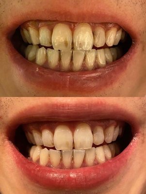 德國原裝進口各大牙醫診所指定使用居家牙齒美白/冷光美白衛部妝輸字號025424號品質有保證/告白黃板牙/牙齒美白劑