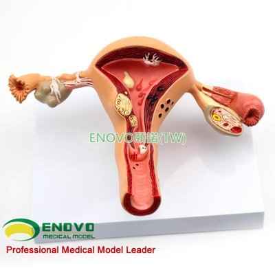 (ENOVO-027) 人體女性子宮卵巢陰道疾病模型生殖科婦產科醫患模型