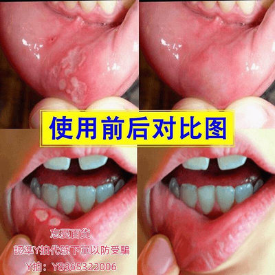 漱口水仁和漱口水用殺菌消除口臭孕婦牙口牙周抑菌消毒護理液