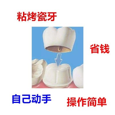 促銷打折 自己動手粘烤瓷牙膠水牙齒鋼牙套牙冠假牙專用牙科膠水粘接劑材料