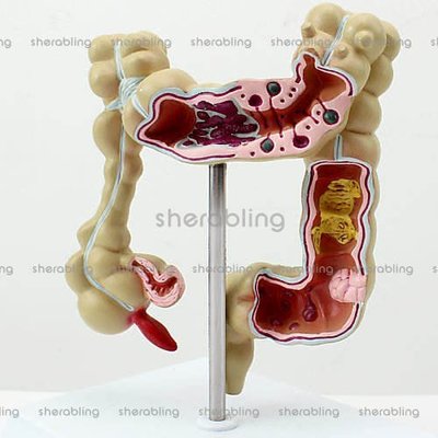 (ME-A090)人體結腸病變模型肛腸科消化科大腸模型醫用人體解