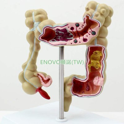 (ENOVO-065) 人體結腸病變模型肛腸科消化內科大腸模型醫學人體解剖
