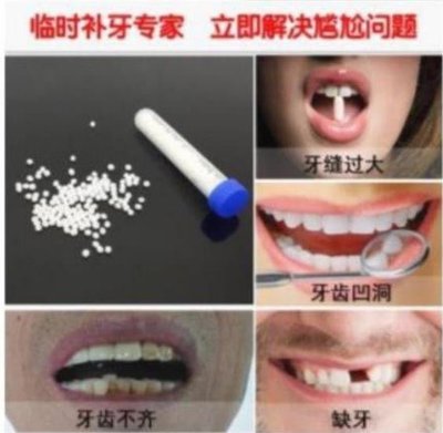美國進口樹脂材料DIY補牙堵牙洞牙縫門牙 臨時假牙化妝補牙自製假牙套