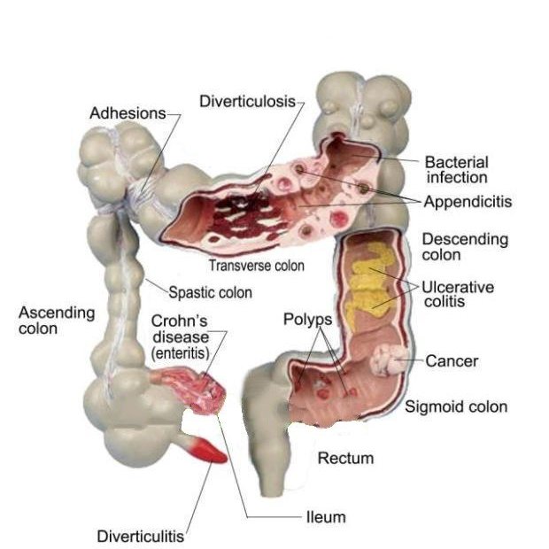 奇滿來】結腸病理模型結腸病變模型大腸模型腸解剖模型腸子解剖醫學教學