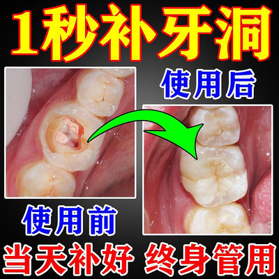 補牙神器自己填充在家補牙材料永久醫用蛀牙牙洞填補膏齲齒修復